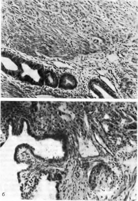 ендометріоз матки