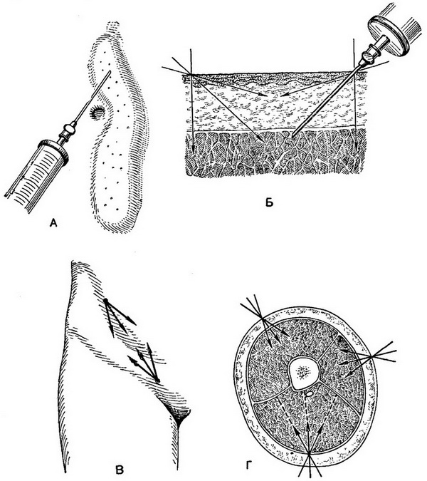 місцева анестезія
