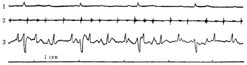 електрокардіограми матері і внутріутробного плода і фонокардиограмма плоду