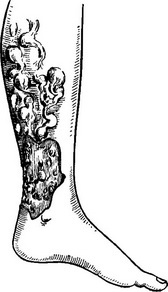 локалізація трофічних виразок