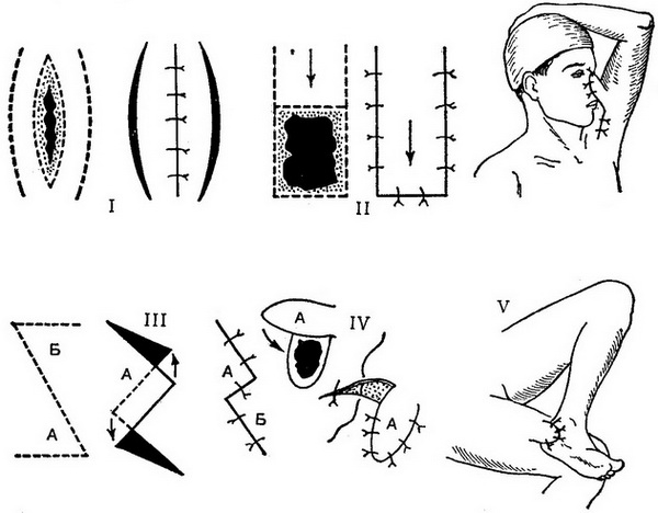 види шкірної пластики місцевими тканинами