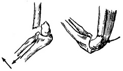схема екстензионного (разгибательного) надмьщелкового перелому плеча