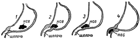 евакуація вмісту шлунка