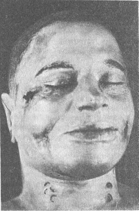 удавление руками