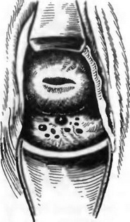 Ендометріоз заднього склепіння піхви