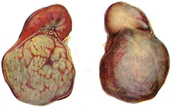 гіпернефрома нирки
