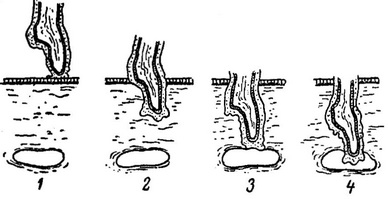 види прищеплення плаценти