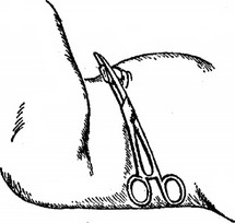 пупковий клем