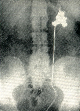 пухлину миски лівої нирки