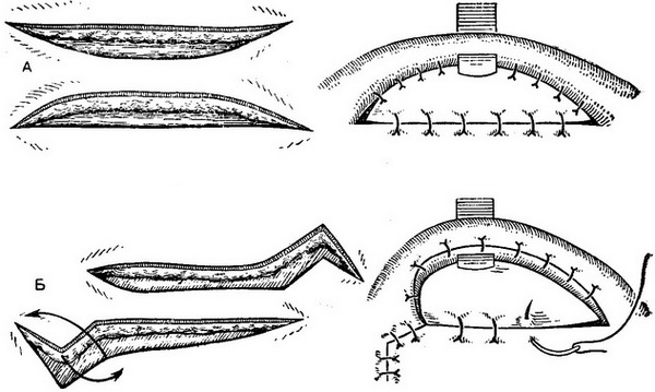 способи викроювання шкірного стебла по філатову