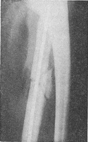 осколковий перелом діафіза променевої кістки