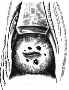 Эктоцервикальный ендометріоз шийки матки