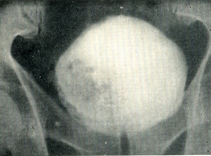 неинфильтрирующая папілярна пухлина сечового міхура