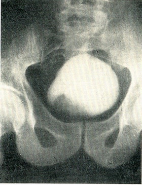 інфільтруючим пухлина сечового міхура