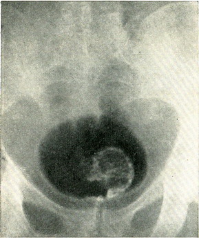 папілярна пухлина сечового міхура