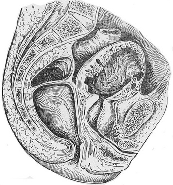 субвезикальная форма аденоми періуретральних залоз