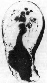 ендометріоз матки