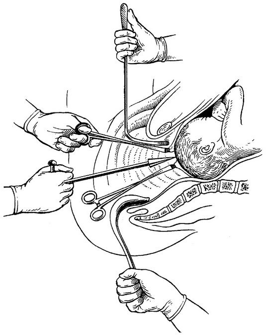 перфорація передлежачої голівки по феноменову