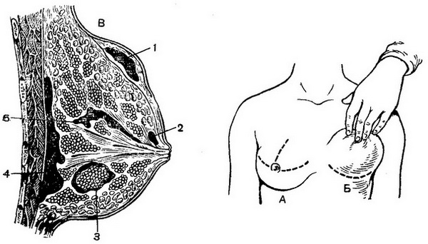 розрізи при маститах