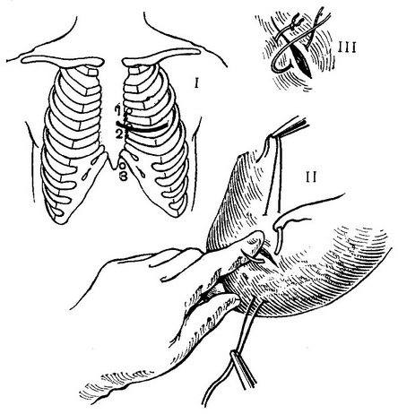 операція ушивання рани серця