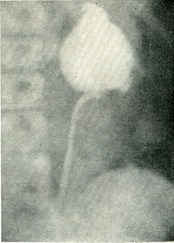 гідронефроз пієлограма.