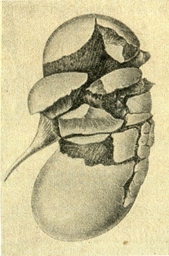 розтрощення нирки