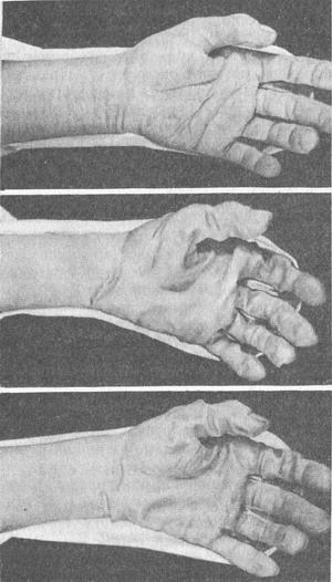 мацерація шкіри кистей