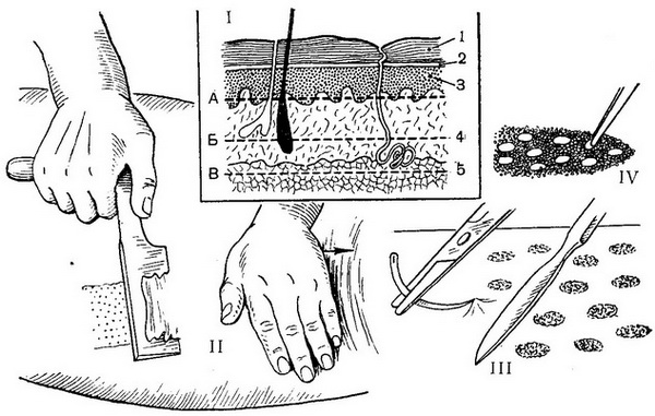методи вільної пересадки шкіри