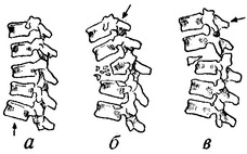 види переломів грудного відділу хребта