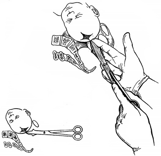 прорив головки ножницевидным перфоратором