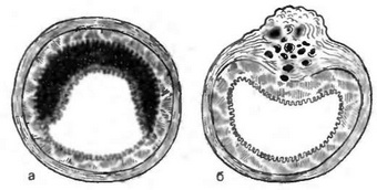 Карцинома та ендометріоз кишки