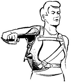 діафізарний перелом плечової кістки відводить шина