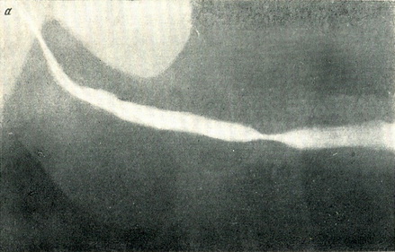 уретрограмма при гонорейній стриктуре