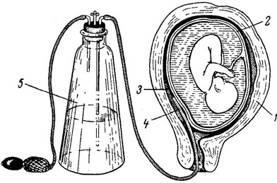 операція заоболочечного вливання