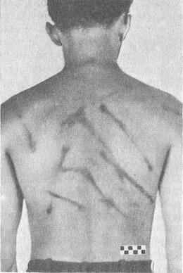 синці від ударів ременем