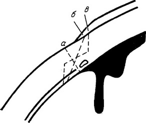 розрізи капсули ока при екстракції катаракти