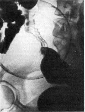 ендометріоз товстої кишки