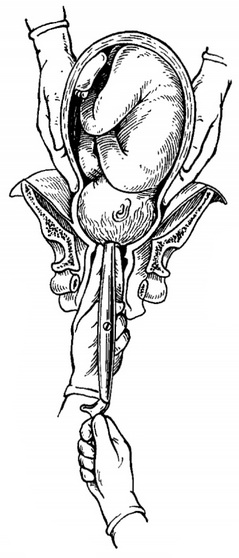 введення масивної ложки краниокласта а порожнину черепа плоду після перфорації