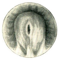 суха уретроскопія