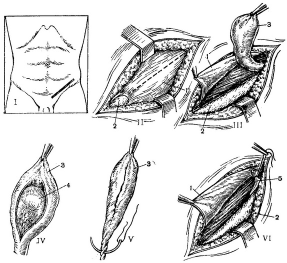 операція при паховій грижі