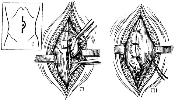 операція при пупкової грижі за способом Сапежко