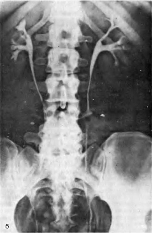 Ендометріоз сечоводів