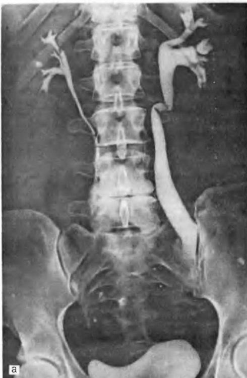 ендометріоз сечоводу