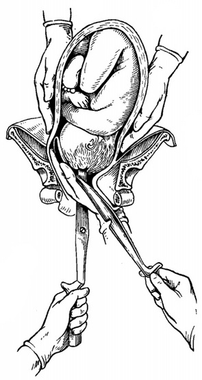 накладення другий ложки краниокласта