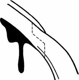 ступенеобразный роговично-склеральний розріз