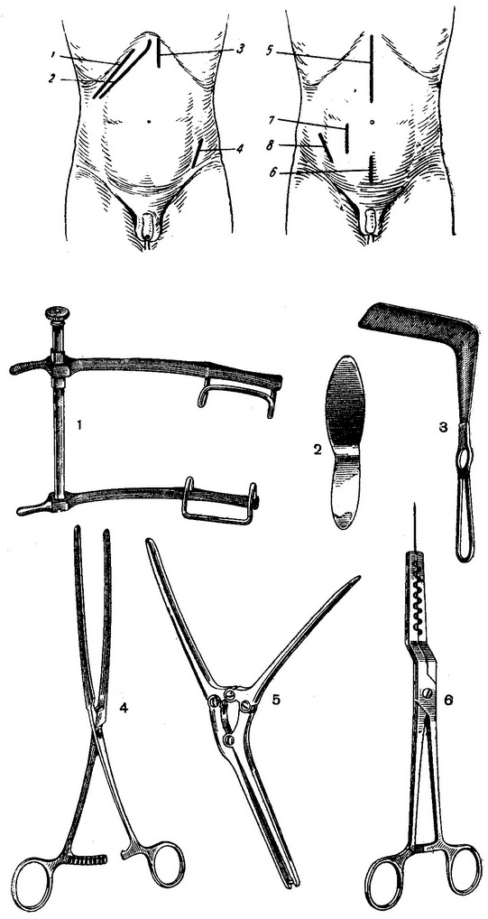 лінії розрізу передньої черевної стінки для доступів до органів черевної порожнини