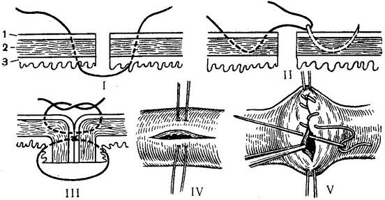 кишковий шов
