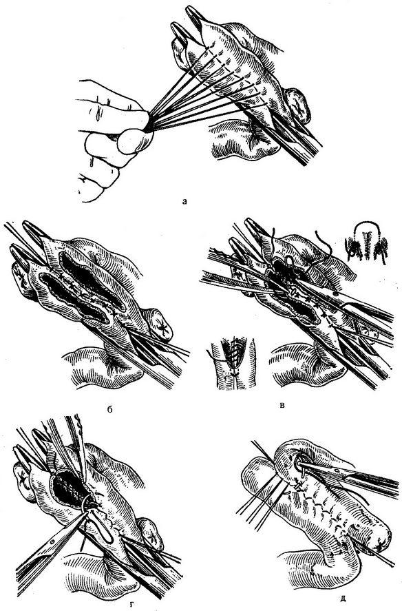 резекція тонкої кишки з анастомозом бік у бік