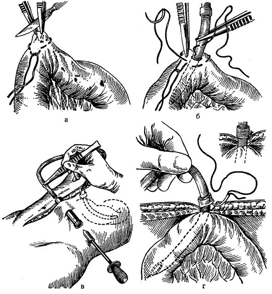 підвісна энтеростомия за Юдину