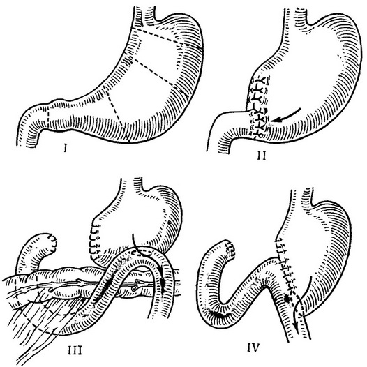 резекція шлунка (схема)